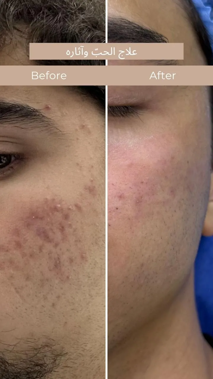 Acne treatment before and after result at Gala Clinics Amman