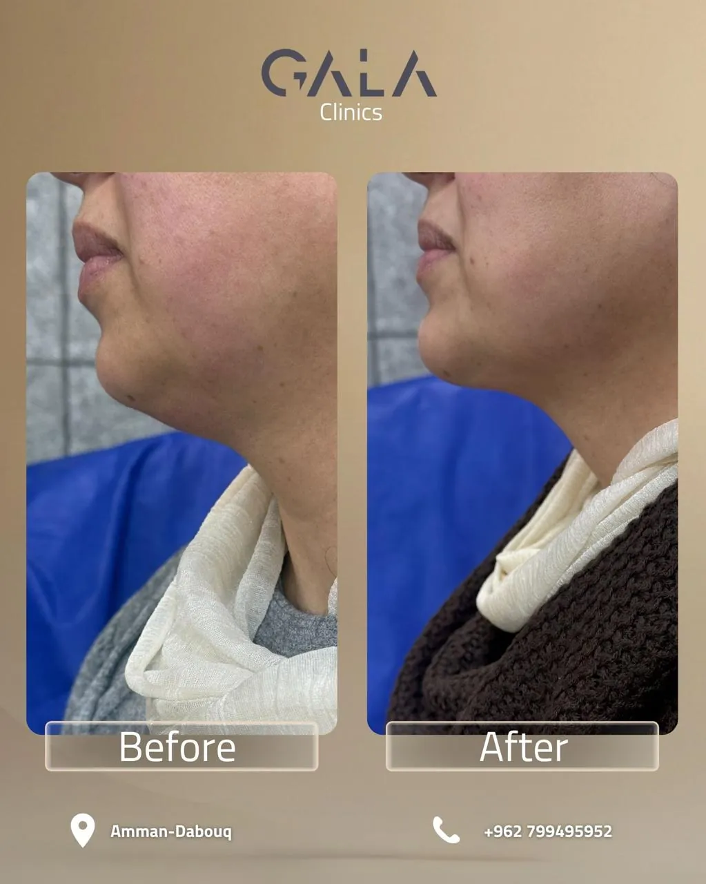 Jawline and chin contouring before and after at Gala Clinics Amman