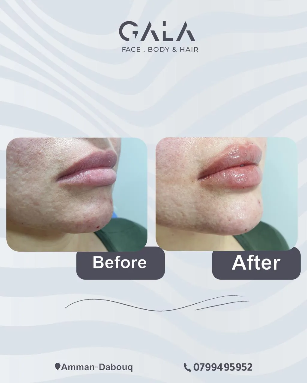 Natural lip enhancement before and after at Gala Clinics Amman