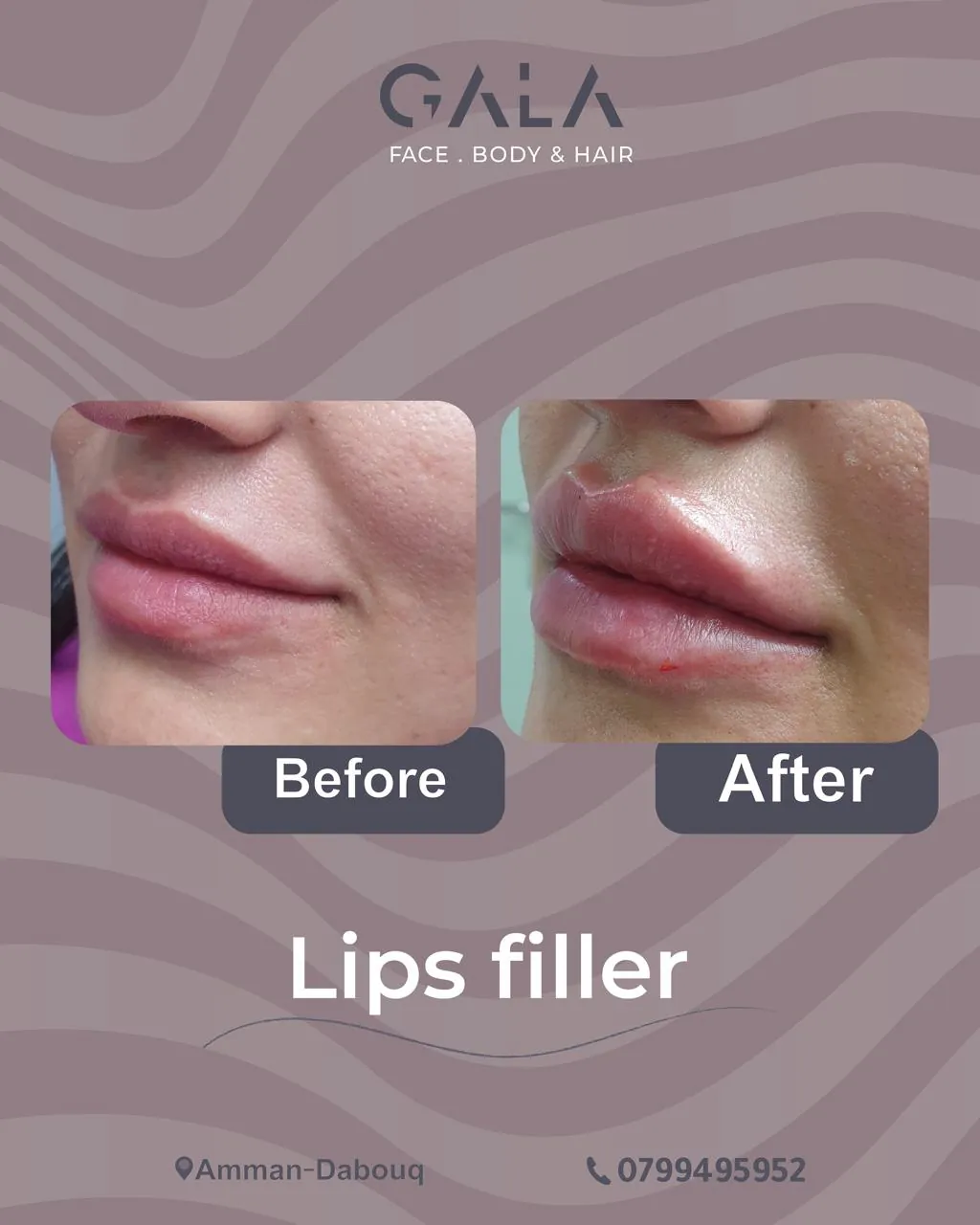 Lip filler before and after result at Gala Clinics Amman